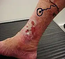 Venous ulcer before surgery