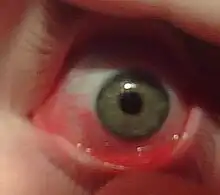 Eye with mild allergic conjunctivitis