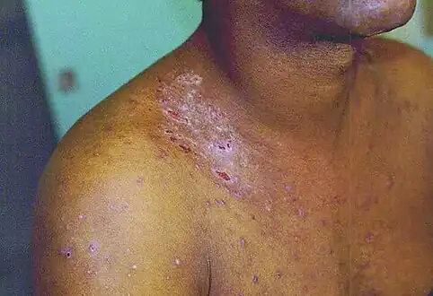 Body lice inject their bites via biological proteins, including an anesthetic that that facilitates fecal transmission of B. quintana[2]