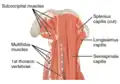 The multifidus muscles (labeled left) as seen in a posterior view of the neck
