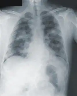 Chest x-ray of pneumonic plague showing bilateral, diffuse interstitial pleural infiltrates, and accompanying consolidation. As well as, what appeared to be marked, mediastinal adenopathy.