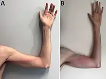 Tender, indurated, erythematous, and well-delimited linear streak from the left finger to the armpit, on the seventh day of illness. B) Aggravated lymphangitis on the ninth day of illness.
