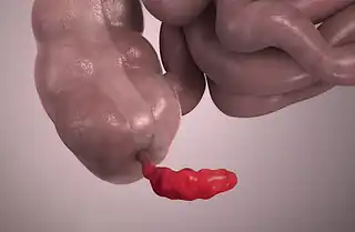 3D still showing appendicitis.