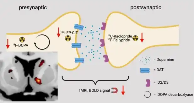 Coronar brain slice shows the reduced dopamine synthesis capacity in the right ventral striatum[73]