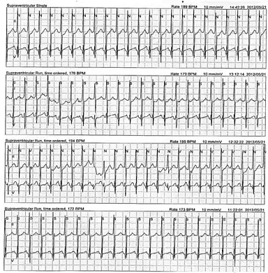 This Holter monitor strip of a 5-year-old showing atrial tachycardia.[7] This person was eventually diagnosed with tachycardia-induced cardiomyopathy.[7]