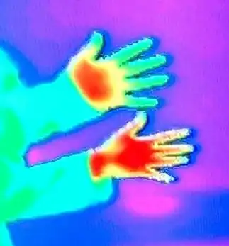 Heat signatures of a Raynaud's hand (top) and a healthy hand (bottom): Red indicates warm areas whilst green indicates cool areas. (Image taken with a thermographic camera)