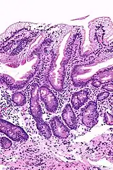 Abetalipoproteinemia - high mag