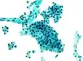 Micrograph of acinic cell carcinoma. Pap stain. Fine needle aspiration specimen.