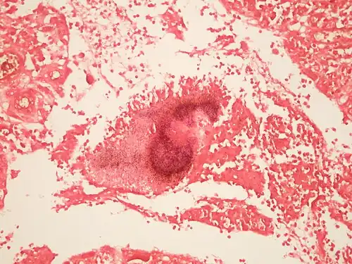 Actinomycosis Gram stain