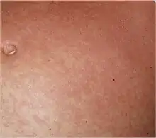 Typical fine-spotted pink rash of acute African trypanosomiasis on the skin of the abdomen (”trypanid rash”)[15]