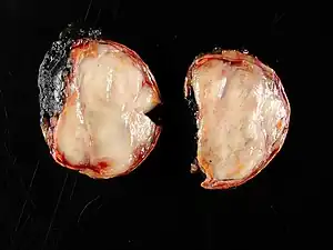 Ganglioneuroma of the adrenal gland