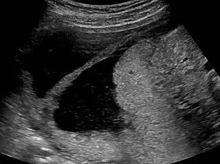 Amniotic sheet on ultrasound