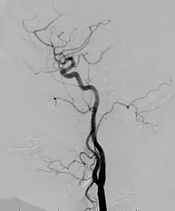 Angiogram