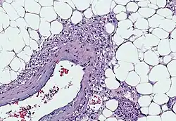 Myoid cells with clear cytoplasm spinning off of large vessels in a background of mature fat, the classic microscopic features of angiomyolipoma