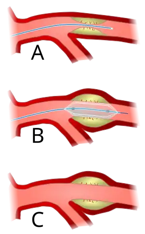 Angioplasty (pictured) and stenting are two endovascular treatments employed by the vascular surgeon.