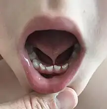 Tongue tie in a 4 year old