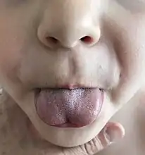 Heart-shaped deformity of the tongue due to tongue tie