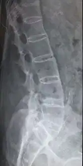 Lumbar spine showing advanced ankylosing spondylitis which can lead to spinal stenosis