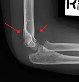 Anterior and posterior sail sign in a child who has a subtle supracondylar fracture