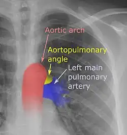 On a posteroanterior chest radiograph like this one, the left margin of the aortopulmonary space is normally seen as the "aortopulmonary angle".