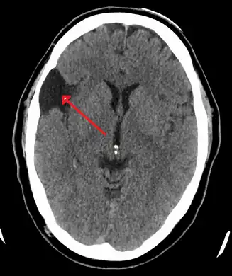 Arachnoid cyst as seen on a CT image of the brain