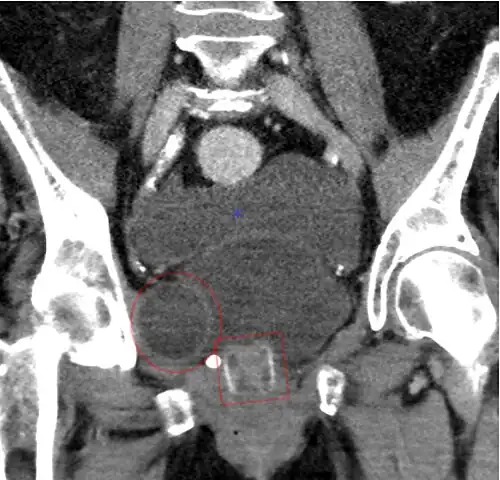 CT scan of an artificial urethral sphincter in a woman