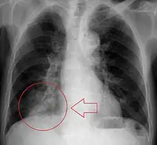 X-ray of pneumonia in lower right lung (bottom left of image) due to aspiration and airway obstruction.