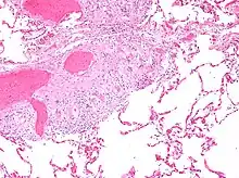 Micrograph showing pulmonary sarcoidosis with granulomas with asteroid bodies, H&E stain