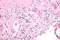 Micrograph of asteroid bodies in pulmonary sarcoidosis. H&E stain.