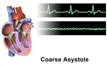 Ventricular fibrillation
