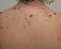A photograph of a human back with nodular acne