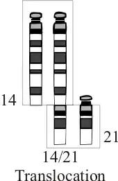Balanced translocation with chromosomes 14 and 21q
