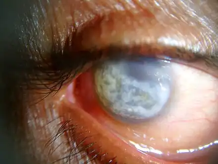 Band keratopathy of a 60-year-old male