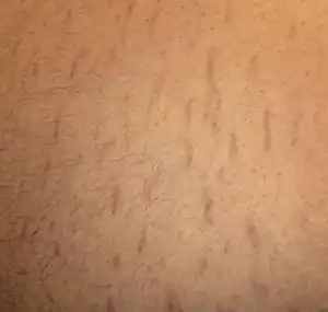 Fuzzy red lines on an abdomen