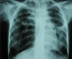 Chest X-ray showing bilateral fibrosis and pleural thickening in infection with non-tuberculosis mycobacteria.