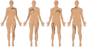 Depiction of Blaschko's lines, patterns present in the skin of a human female, male