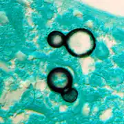 Large, broadly-based budding yeast cells characteristic of Blastomyces dermatitidis in a GMS-stained biopsy section from a human leg
