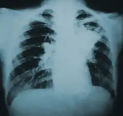 Chest X-ray(lung infiltration)