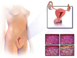 Location of cervical cancer and an example of normal and abnormal cells
