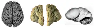 Normal human adult cerebrum (gyrencephaly)(left), polymicrogyria (center) and lissencephaly (right).