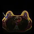 MRI showing breast cancer