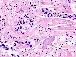 Histopathology of invasive ductal carcinoma of the breast representing a scirrhous growth. Core needle biopsy. Hematoxylin and eosin stain.