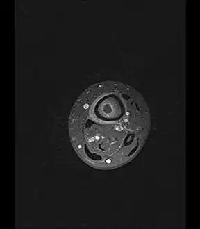 Axial T1-weighted fat-saturated MRI image following IV gadolinium contrast demonstrating the intramedullary lytic area seen on radiography to be ring enhancing consistent with a purulent fluid collection. Extensive circumferential periosteal enhancement is noted. There is also substantial bone marrow enhancement.