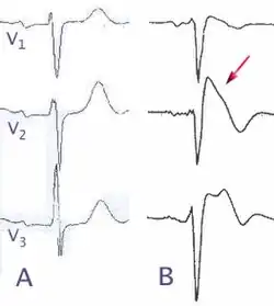 Normal electrocardiograms compared to electrocardiograms of people with Brugada Syndrome