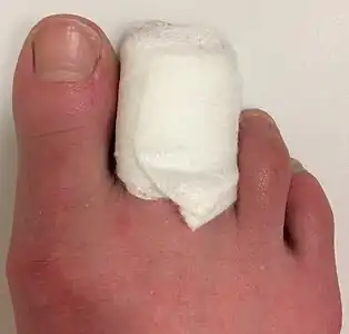 second and third toes wrapped In padding and a bandage, leaving the big toe free