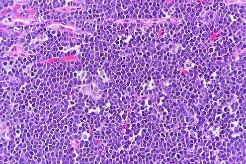 High-power view of Burkitt lymphoma with "starry sky" appearance. H&E stain.