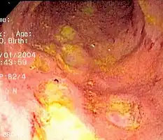 Endoscopic image of Crohn's colitis showing deep ulceration