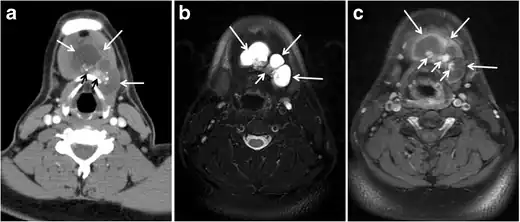 Fig. 21. Papillary thyroid carcinoma arising from a thyroglossal duct cyst in a 28-year-old male. an Axial enhanced CT scan shows a large complex cystic lesion (white arrows) adherent to the anterior aspect of the hyoid bone. It has an enhancing mural solid nodules and calcifications (black arrows). There is no cervical lymphadenopathy. b Axial short tau inversion recovery (STIR) MRI image near the same level shows complex lesion of high signal intensity (long white arrows) with solid mural nodules (short white arrow). c Axial fat saturated T1 MRI image post contrast administration shows the complex cystic lesion with thick enhancing wall (long white arrows) and enhancing mural nodules (short white arrows).