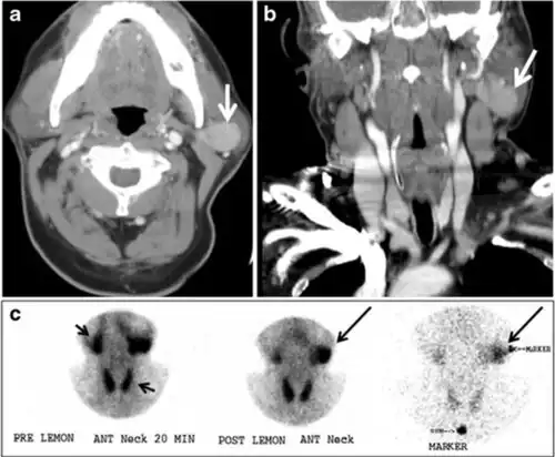 Fig. 17. Ectopic thyroid on the left parotid gland with a palpable left parotid mass in a 69-year-old male patient. a, b Axial and coronal enhanced neck CT scan demonstrates well-defined homogeneous enhancing mass (white arrows) within the left parotid gland with preserved surrounding fat planes. It also shows a normal thyroid in normal position in the lower neck. c Image taken 20 minutes after 5 mCi injected Tc99m-Pertechnetate shows normal thyroid uptake of tracer and physiological uptake in the salivary glands (short black arrow). There is a distinct focus of abnormal tracer accumulation in the left parotid/submandibular region. Patient was given lemon juice with evident normal washout from the salivary glands and relative retention by this abnormal focus (long black arrow).