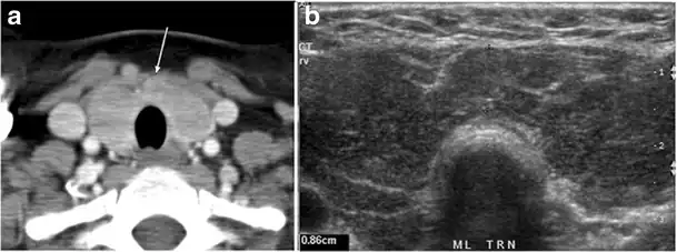 Fig. 15. A 33-year-old female patient who presented with neck swelling and pain and was later diagnosed with Hashimoto's thyroiditis. an Axial enhanced CT scan of the neck demonstrates minimal diffuse enlargement of the thyroid gland, especially the isthmus (white arrow). b Transverse greyscale ultrasound of the neck demonstrates heterogeneously enlarged thyroid and thickened isthmus, measuring 8.6&nbsp;mm.